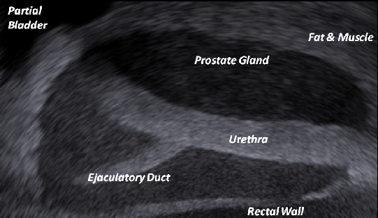 Prostate phantom - Exact Ultrasound ecogenicity as seen by surgeons in the Operating Room